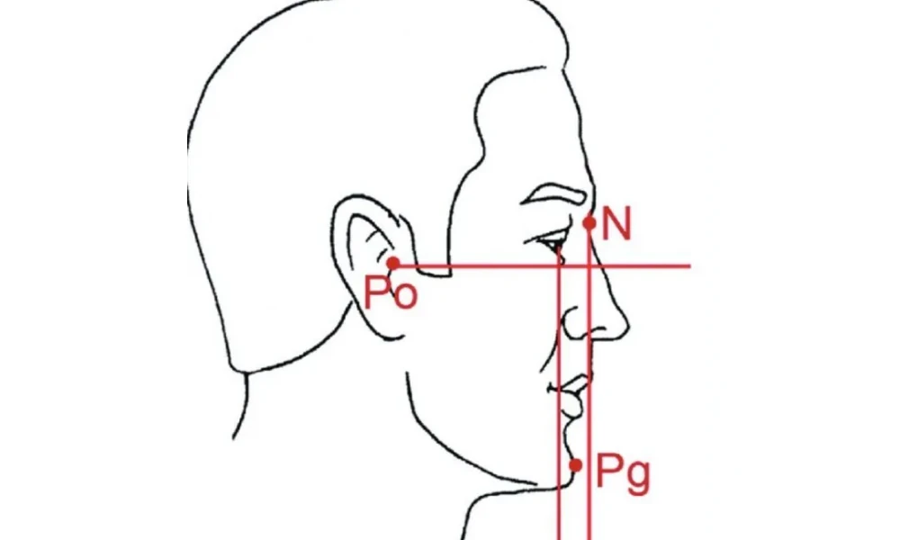 Clinical photo from Emma's chin implant augmentation case